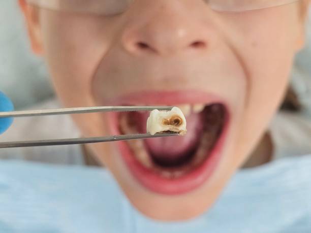 Best Chipped Tooth Repair Near Me  in Mineralwells, WV